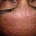 Preventing and managing common skin conditions